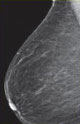 mammogram image showing almost entirely fatty breast tissue, categorized as Type A densite